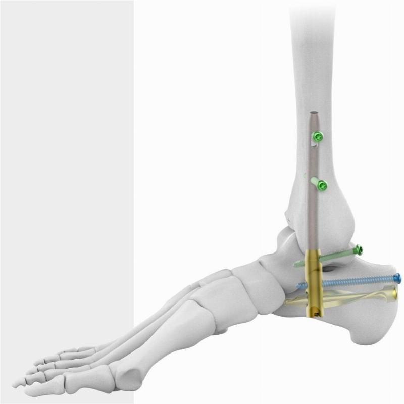 Auxein - Tarsus Стрижень